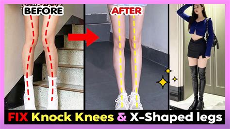 BEST EXERCISE TO FIX KNOCK KNEES X Shaped Legs Get Straight