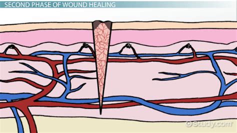 The Three Phases Of Wound Healing Video And Lesson Transcript