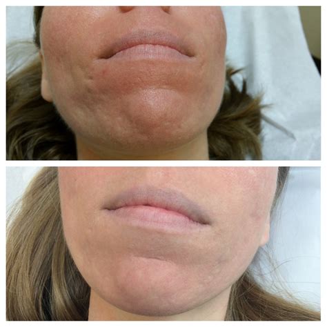 Fractional Laser Scar Treatment Services Skin Resurfacing