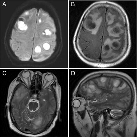 Disseminated Nocardiosis With Subretinal Abscess In A Patient With