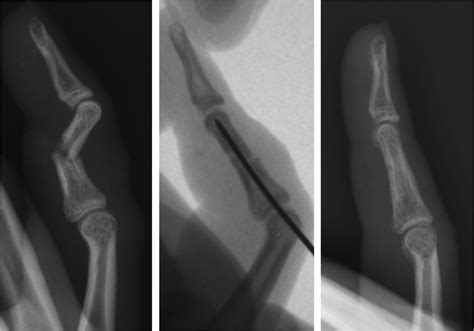 Hand Fracture Raleigh Hand Surgery — Joseph J Schreiber Md