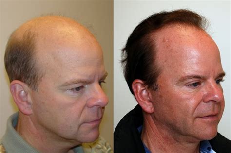 NORTHWEST HAIR RESTORATION 13 Photos 19 Reviews 1201 Pacific Ave