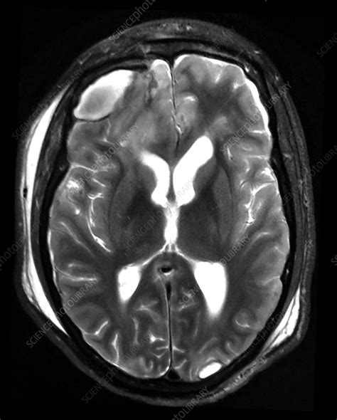 Traumatic Brain Injury Mri Stock Image C0432968 Science Photo