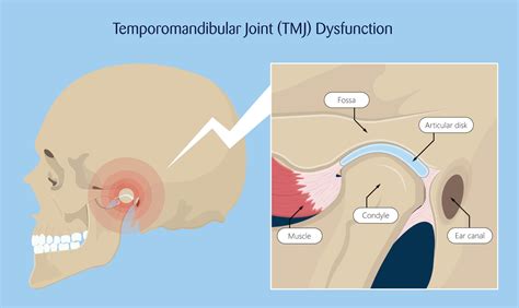 Temporomandibular Joint Diagram