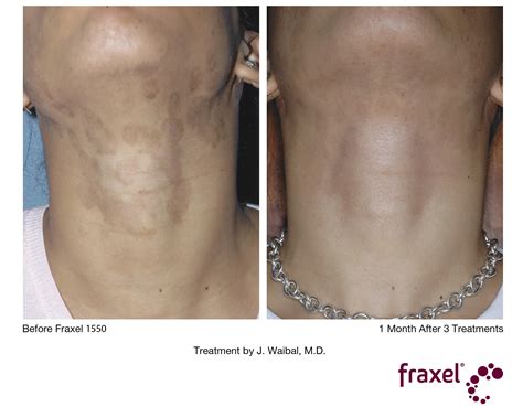 Fraxel Treatments At Long Island Garden City Great Neck Hamptons