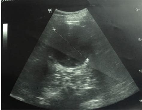 Abdominal Ultrasound Showed Multiple Simple Cysts On Both Kidneys With