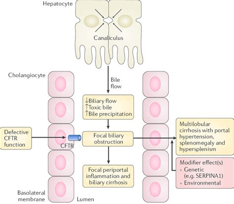 Proposed Pathogenesis Of Liver Disease Related To Cystic Fibrosis In