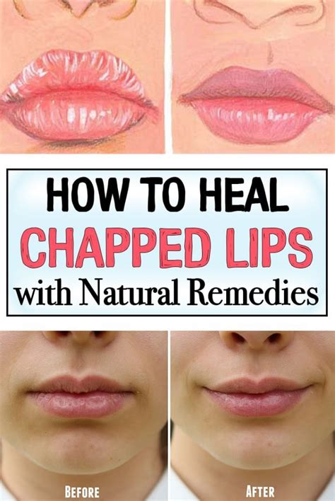 How To Heal Chapped Lips With Natural Remedies Iwomenhacks