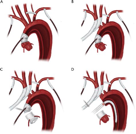 Main Steps Of The Procedure A Both Axillary Arteries Are Exposed And