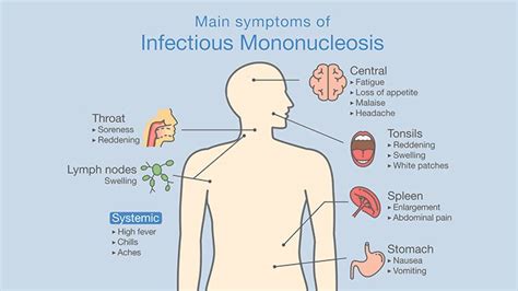 How You Know You Have Mononucleosis Everyday Health