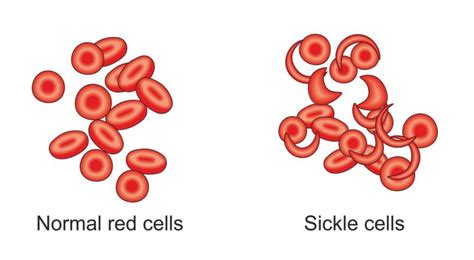 Sickle Cell Anemia Vs Normal Blood Cells
