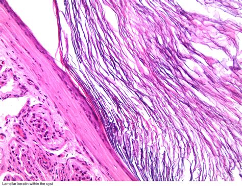 Pathology Outlines Epidermoid Cyst