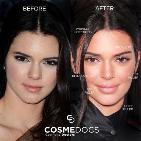 Kendall nicole jenner (born november 3, 1995) is an american model, socialite, and media personality. Kendall Jenner in 2020 | Brow lift, Kendall jenner nose ...