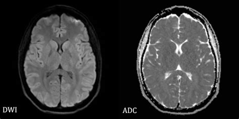 Diffusion Weighted Imaging Of Normal Brain Mri Dwi And Adc Map