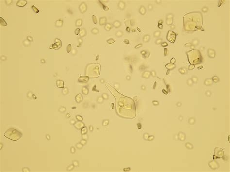Raised uric acid levels in the body are a point of concern as they not only affect the joints but also the digestion. Microscopic Analysis of Urine | Faculty of Medicine ...