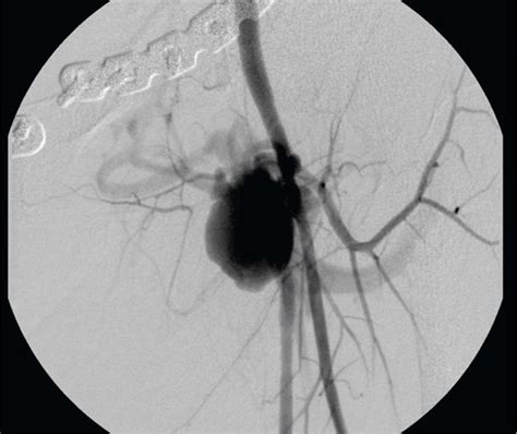 A Pseudoaneurysm Of The Left Superficial Femoral Artery Due To A