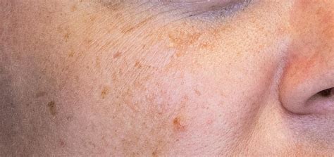 Pigmentation Removal With Laser What To Expect B Clinic