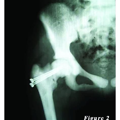 Postoperative Radiography Of The First Patient Download Scientific