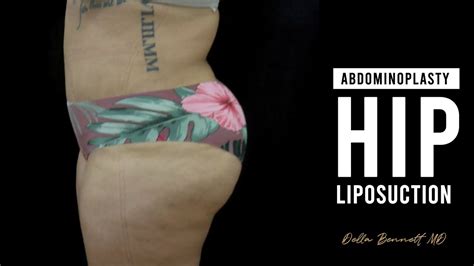 Before And After Liposuction Hip Liposuction Procedure
