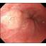 Endoscopy Showing A Pale Colored 10 Mm Submucosal Tumor Like Lesion 