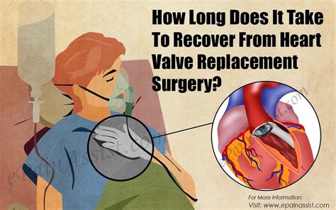 How Long Does It Take To Recover From Heart Valve Replacement Surgery