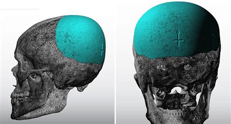 Plastic Surgery Case Study Custom Skull Implant For Occipital