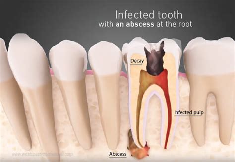There was also a left upper rear tooth (molar) with a cyst that has in some patients, their upper molars may protrude into the maxillary sinus. Can A Ct Scan Show Tooth Infection - ct scan machine