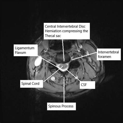 Cervical Disc Herniation