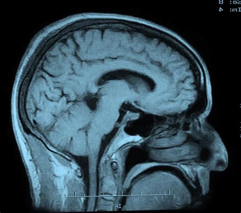 What Is A Brain Ct Scan With Pictures