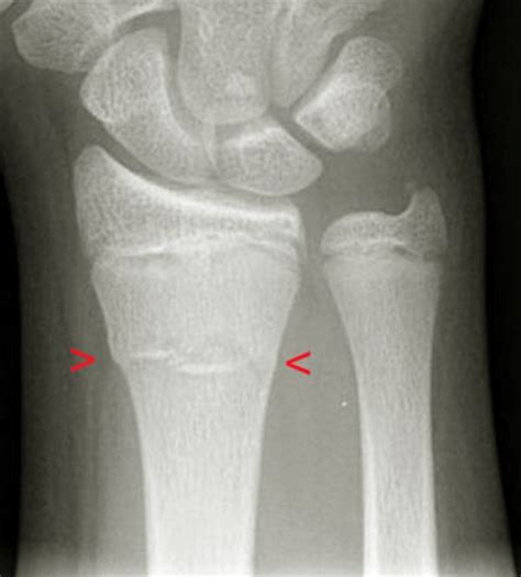 Buckle Fracture Pictures Healing Time Treatment Causes