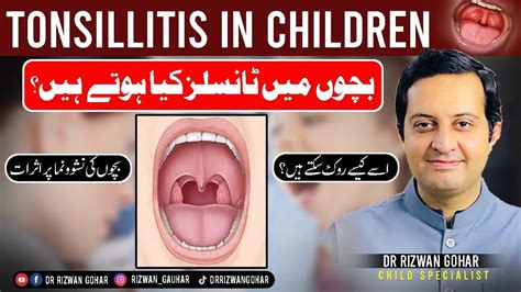 Tonsillitis In Children Dr Rizwan Gohars Exclusive Tips To Treat It