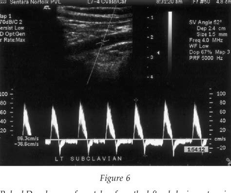 Figure 6 From Pan Diastolic Flow Reversal In The Subclavian Artery An