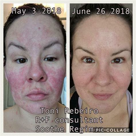Rodan Fields Soothe Regimen Is Clinically Proven To Reduce Redness