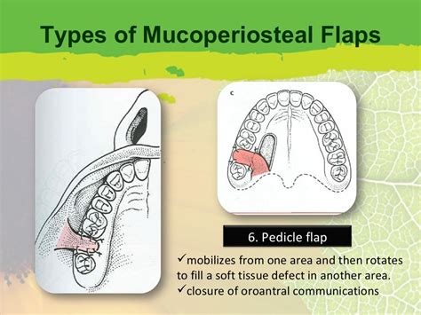 Flap Design For Minor Oral Surgery