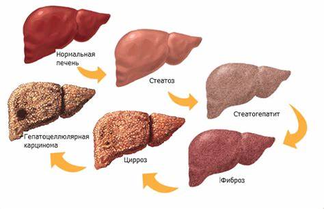 Алкогольная болезнь печени Картинка - Алкогольная болезнь печени