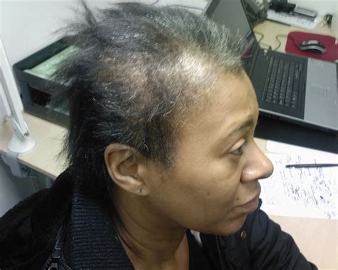 Female hair fall and hair loss is an issue that can be resolved with care and a regular routine of oiling. Black Women Hair Loss Find out more at the ...