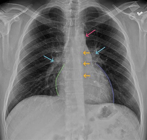 Chest X Ray Anatomy For Medical Students