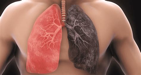 Diferencias y relación entre bronquitis crónica Enfermedad Pulmonar