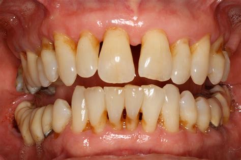 Periodontitis Omni Dental Group Classification Of Periodontal