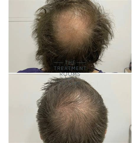 Balding Crown And Crown Hair Transplant Treatment Rooms London