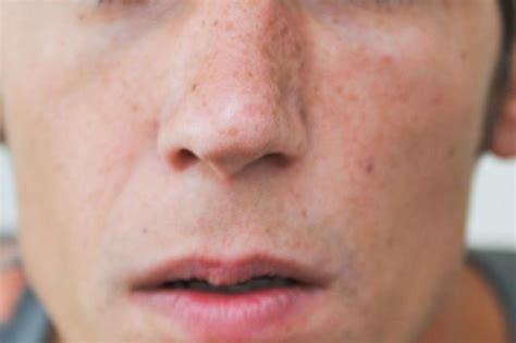 How To Reduce Redness Around Nose