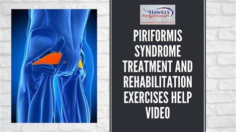Piriformis Syndrome Treatment And Rehabilitation Exercises Help Video