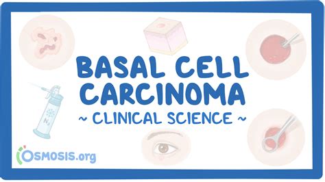 Basal Cell Carcinoma Clinical Sciences Osmosis Video Library
