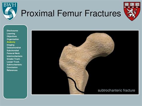 Proximal Femur Fractures By Jeffrey Shyu Md