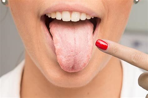Oral Thrush Symptoms Causes And Treatments Vdm Dental Blog Ny