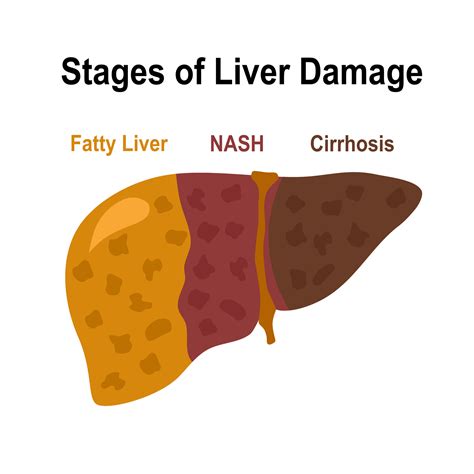 Nonalcoholic Fatty Liver Disease Is My Liver Damage Reversible
