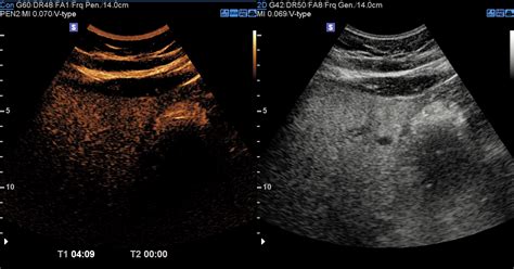 Hemangioma In Hepatic Steatosis Ceus Image