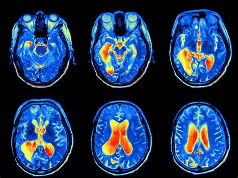 Be a part of something that cares it would have been interesting to look at the scan and see signs of potential bipolar in my brain, but like several people. Guidelines for Using fMRI for Presurgical Evaluation of ...