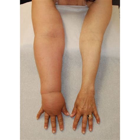 Lymphoedema Hand Upper Limb Centre