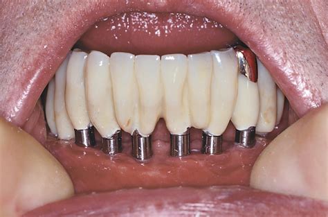 implantat krone bro protese strøget tand